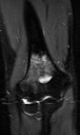 Figure 2 for case Osteoid Osteoma